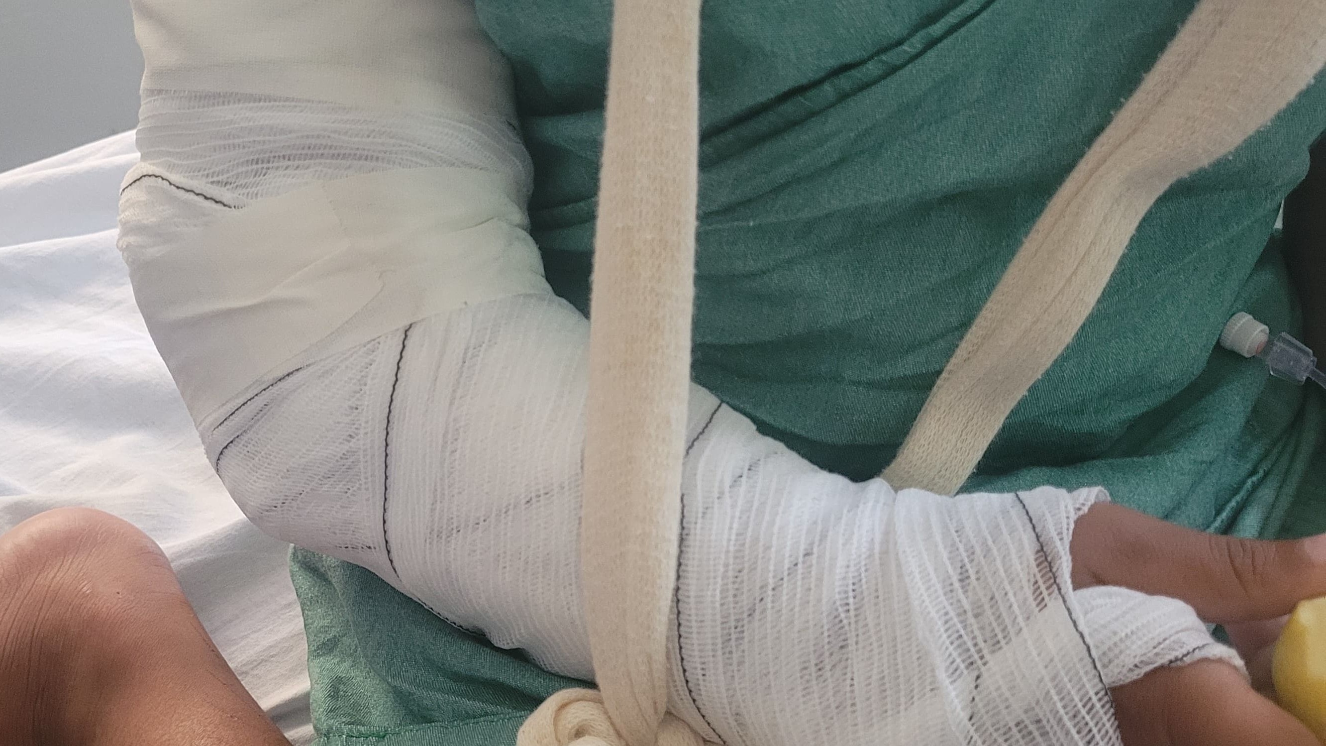 a imagem mostra o detalhe do braço de uma criança enfaixado